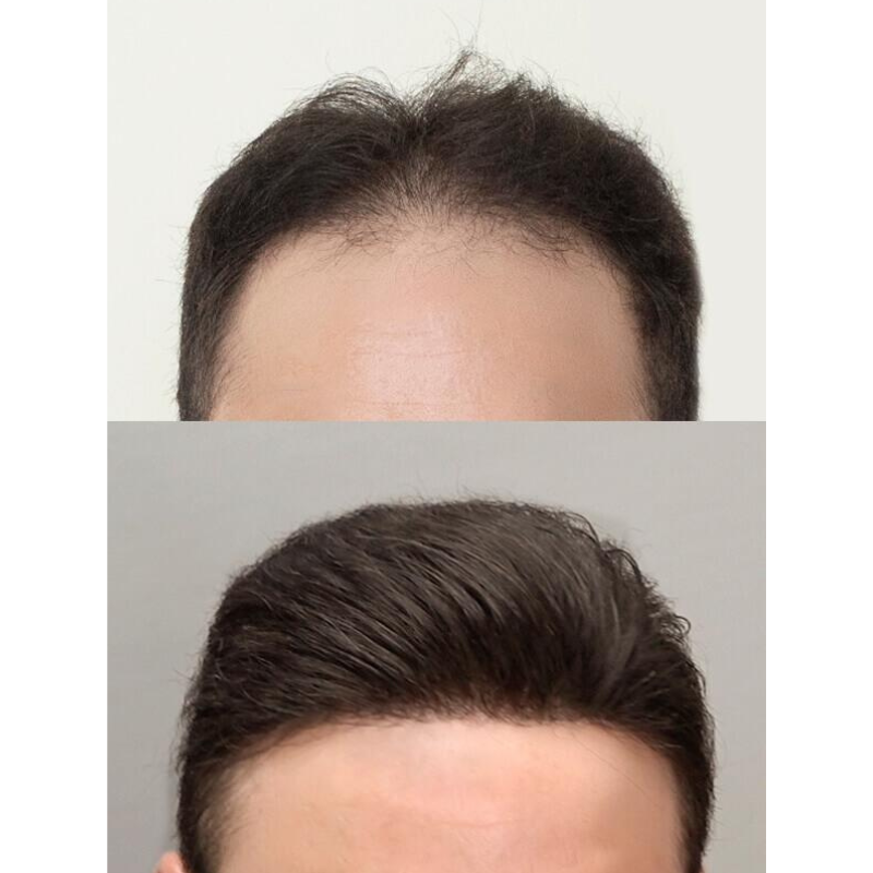 Men Forehead Hairline Toupee 100% Human Hair Skin PU Frontal Hair Patch