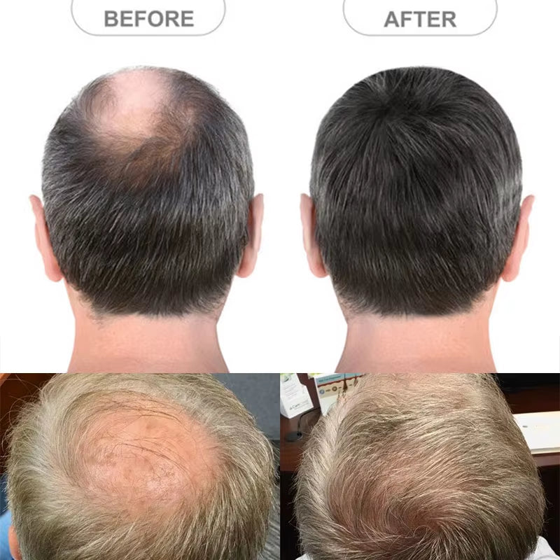 Side or Back Hair Patches for Men, Hairpiece for Men, Cover Bald Spot On Head, Thin Skin, Toupee Patch, 8 x 8 cm