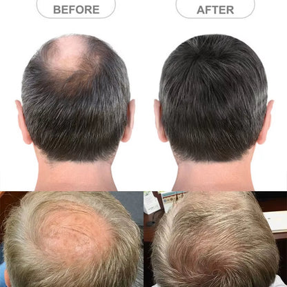 Side or Back Hair Patches for Men, Hairpiece for Men, Cover Bald Spot On Head, Thin Skin, Toupee Patch, 8 x 8 cm